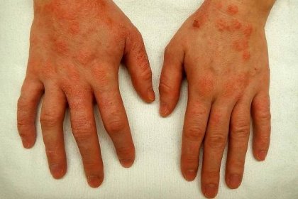 Jak na alergický ekzém: od příznaků po účinnou léčbu