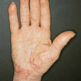 Hyperkeratotický ekzém rukou a nohou - příznaky a léčba