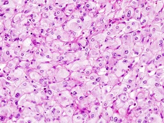 Nádory neuroektodermové – WikiSkripta