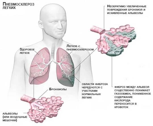 Co Je Fibroza Seznam Cz