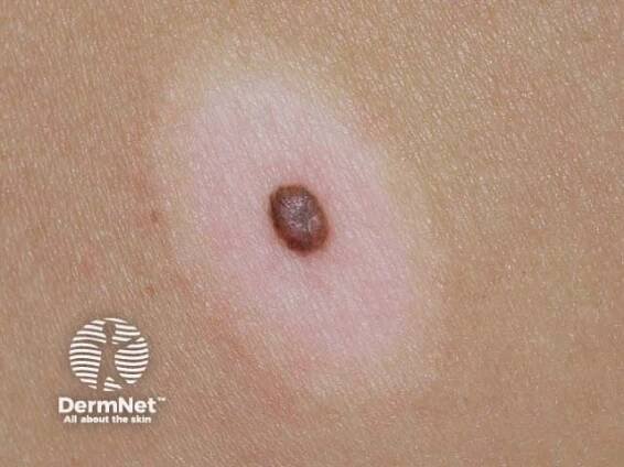 Moles (melanocytic naevi, pigmented nevi)