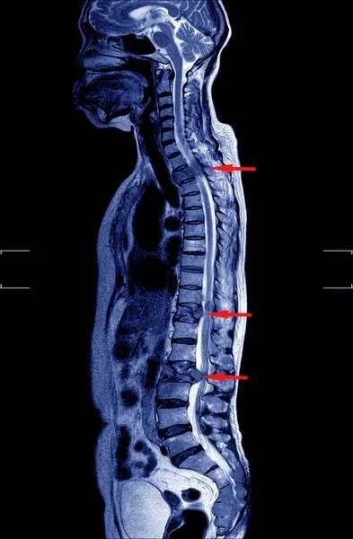 MRI THORAKOLUMBÁRNÍ ŠPINY Snížená lumbosakrální lordoza bez spondylolistézy.Středně patologická komprese hladin T11 a L2 se zvýšením mnohočetných lézí dřeně na hladinách T1, T10 až T12, L2, L3 až L5. — Stock obrázek