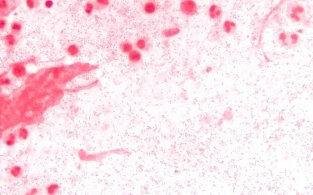 Existuje několik typů hemofilu, nejzávažnější infekce jsou způsobeny typem b - Hib. Infekce se přenáší kapénkově z člověka na člověka.