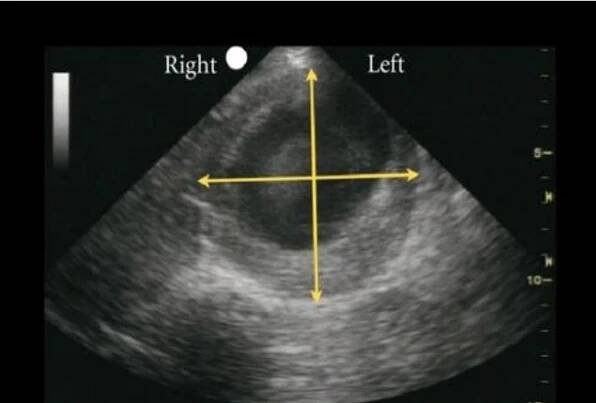 Vyšetření aneurysmatu abdominální aorty v rámci screeningového programu pro muže - MojeRadiologie.cz