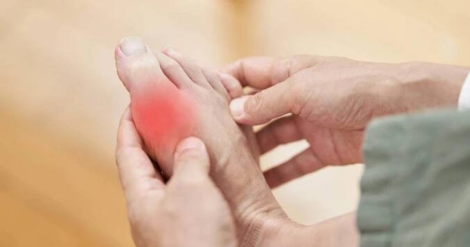Myths about gout—and the facts