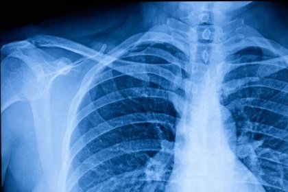 rentgenový film lidské hrudní dutiny - klíční kost - stock snímky, obrázky a fotky