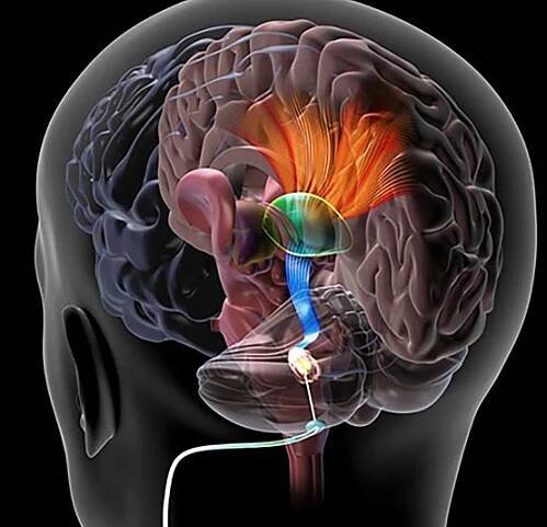 A study has found that deep brain stimulation paired with physical therapy assists with post-stroke rehabilitation