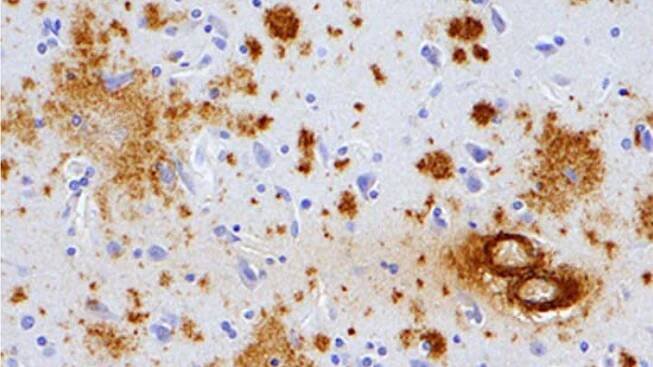 Nová štúdia našla prepojenie očkovania s rizikom vzniku Alzheimerovej choroby