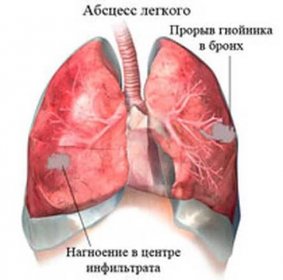 Plicní absces, co to je a jak se léčit? / Absces