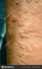 Kožní vyrážka, kopřivka, alergická reakce pokožky. — Stock Fotografie © areeya #154493232