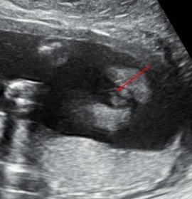 Těhotenství | Ultrazvuk 21tt - Holka nebo kluk?