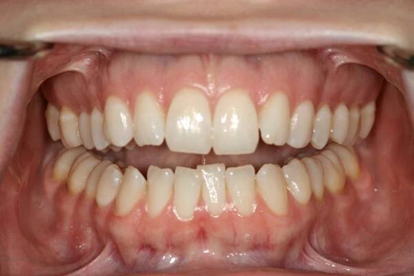 My bite, with teeth clenched. Pre-braces and surgery.
