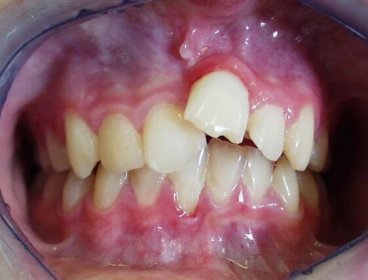 SANQUIS - SANQUIS PLUS - Co jsou ortodontické anomálie a jak je léčíme?