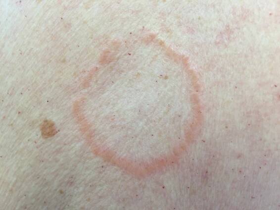 Granuloma Annulare - Appalachian Spring Dermatology Zdravý Způsob Života, Domácí Léčivé Prostředky, Přirozená Léčba
