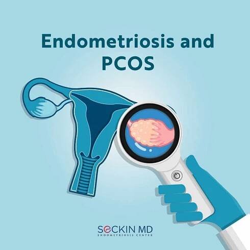 Endometriosis and PCOS