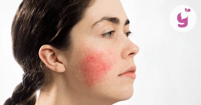 Rosacea na tváři – jaké jsou její příznaky a co může pomoct