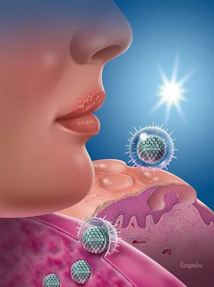Herpes simplex virus (HSV) and sunlight trigger
