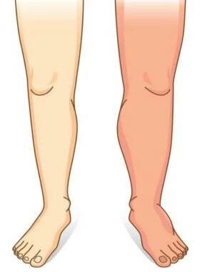 bolest-nohou