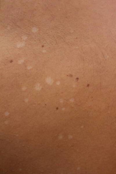 porozumění tinea versicolor: zvládání a léčba pityriasis versicolor - pityriasis versicolor - stock snímky, obrázky a fotky