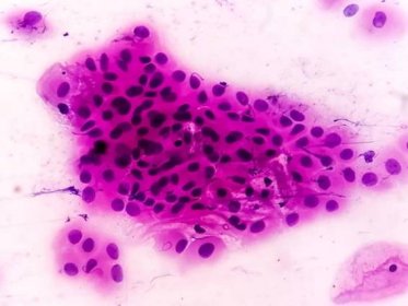 papův nátěr pap skvrna mikroskopické 100x zoom show vysoce kvalitní dlaždicová intraepiteliální léze je prekancerózní, pohlavně přenosná nemoc - skvamocelulární karcinom - stock snímky, obrázky a fotky