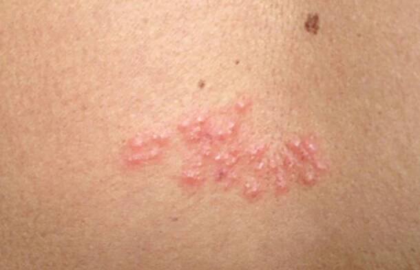 Živa – Virostatická léčba včera a dnes: Zatím proti virům vedeme na body
