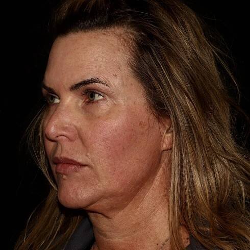 Emface Before JH. Non-surgical facelift. mini facelift. needle free face lift. dermatology of the rockies. longmont. Boulder. Erie. Best medical spa near me.