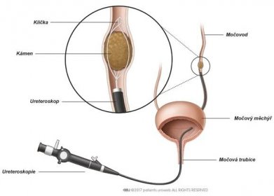 Co je to Ureteroskopie?