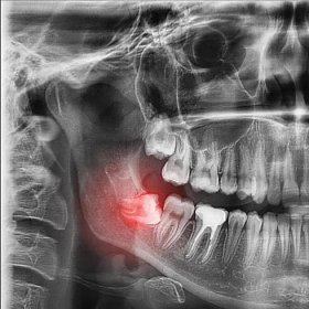 rentgenovégrafy zubů - stolička zuby - stock snímky, obrázky a fotky
