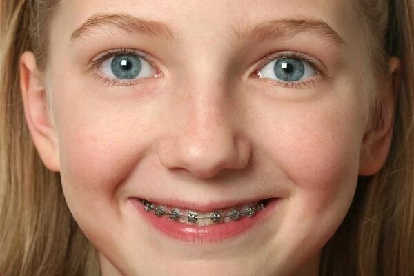 Young girl with dental braces on her teeth isolated on white. Young pretty teen blond girl stock images, royalty-free photos and pictures