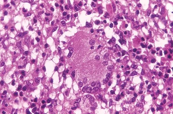 Mycobacterium