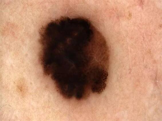 Melanom pod dermatoskopem Zdroj: LC Anděl