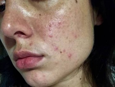 I Quit Drinking Alcohol and Improved My Skin - Before and After Photos