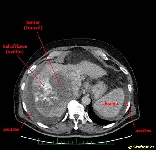 Nález 24 - Hepatocelulární karcinom | Medicína, nemoci, studium na 1. LF UK