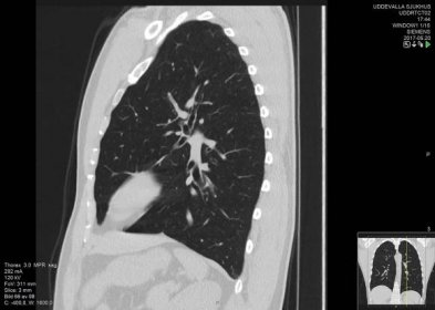 Scrollable high-resolution computed tomography images of a normal thorax - Wikimedia Commons