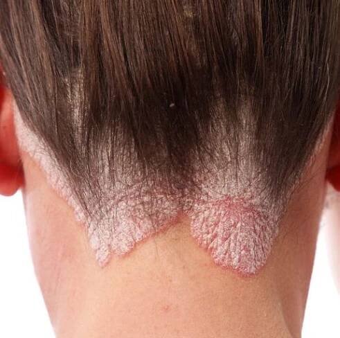5 Best Scalp Psoriasis Treatments That Actually Work, According to Dermatologists