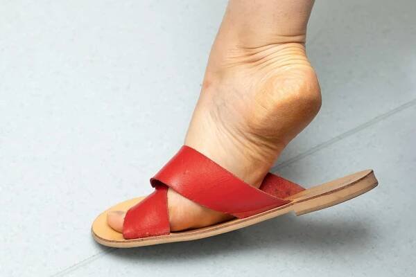 Caring for Rough Skin on Heels - Tips from Shuman Podiatry - Sterling VA