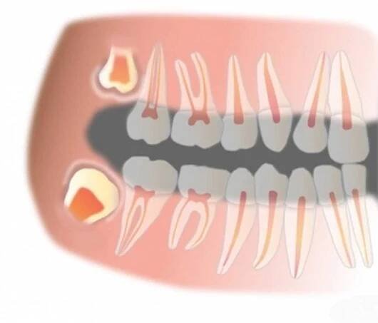 Layton WIsdom Teeth Removal & Impacted Tooth Pain - Layton Hills
