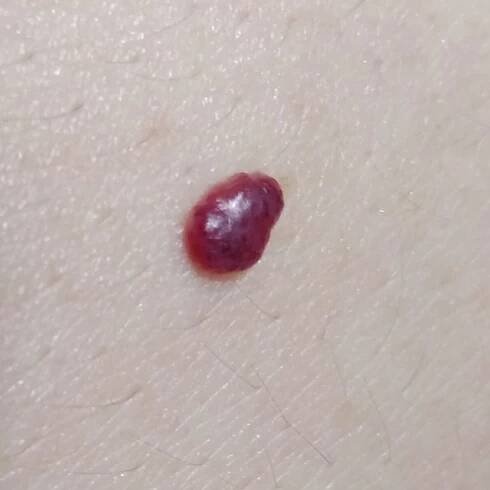 Hemangioma (ICD 10: D18) - Online consultation AI dermatologist