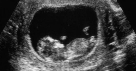 Lékař budoucí rodiče před snímkem z ultrazvuku důrazně varoval. To, co viděli, jim nahnalo husí kůži