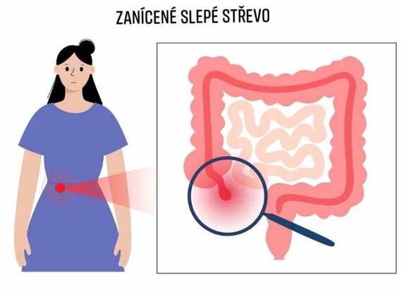 Slepé střevo – kde je, příznaky zánětu, diagnóza - MZ.cz