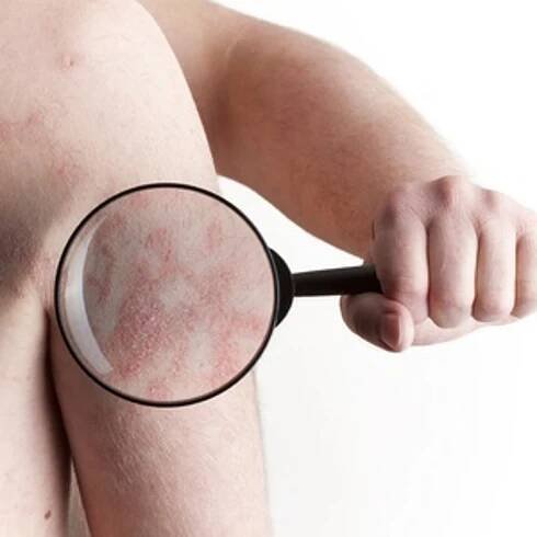 Aké sú príčiny vzniku psoriázy?