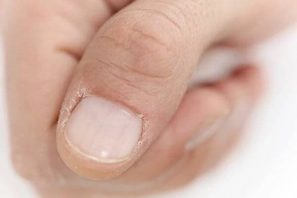 Popraskaná pokožka na rukou a chodidlech | Eucerin