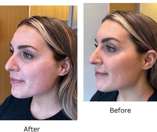 Jaw Filler: Everything You Need to Know About Volux in 2023