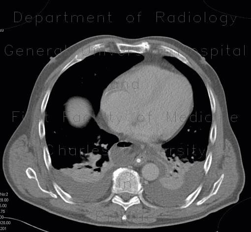 Pneumoperitoneum, mimic of epiphrenic diverticulum