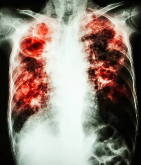 Mycobacterium tuberculosis infekce (plicní tuberkulóza) — Stock obrázek