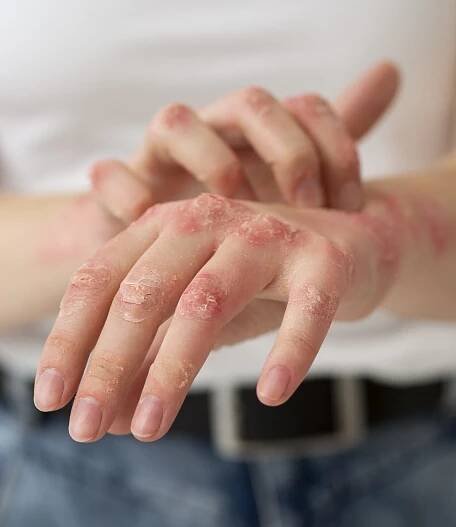 HOMEOPATHIC MEDICINE FOR PSORIASIS - HOMOEO HEALING