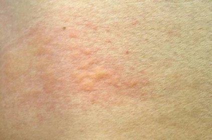 Kožní vyrážka, kopřivka, alergická reakce pokožky. — Stock obrázek