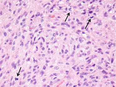 Astrocytom IDH mutant CNS WHO stupeň 3