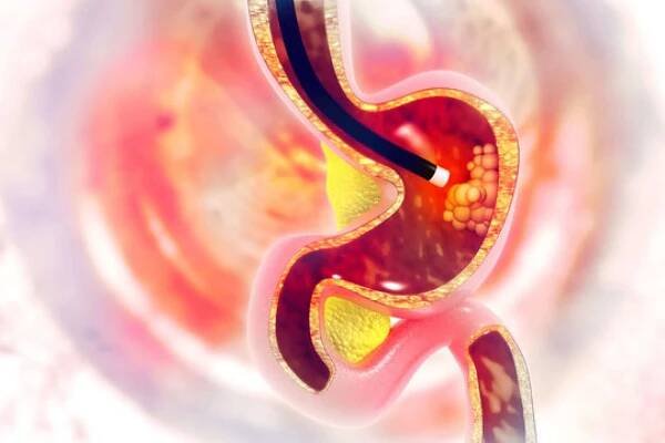 Aby se rakovina žaludku potvrdila či vyvrátila, provádějí lékaři endoskopické vyšetření. Zdroj: Shutterstock