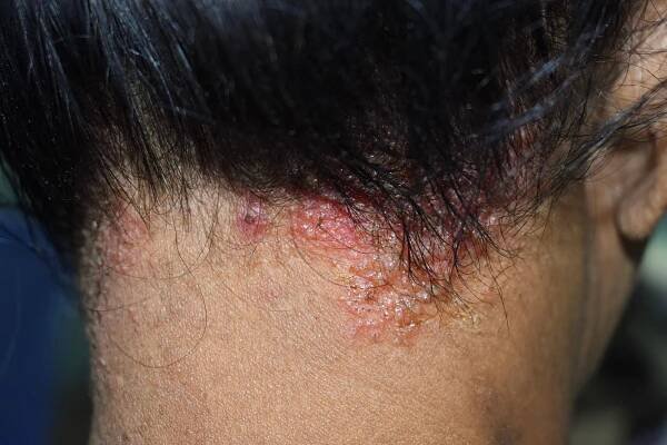 seboroická dermatitida nebo plísňová kožní infekce na pokožce hlavy jihovýchodní asie, myanmar dospělé ženské pacientky. - svrab - stock snímky, obrázky a fotky